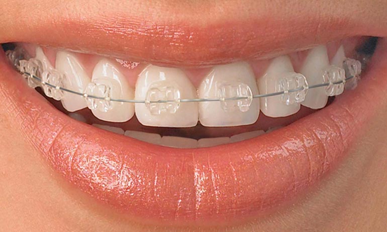 aparelhos-ortodonticos